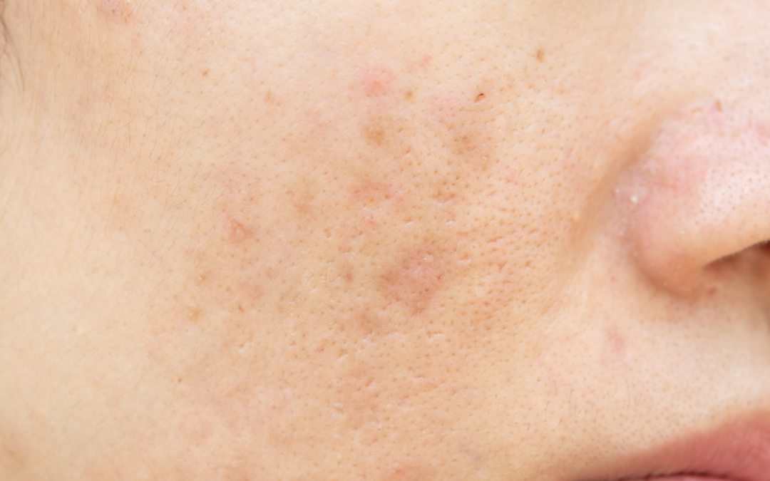 Hypopigmentation and Age Spots