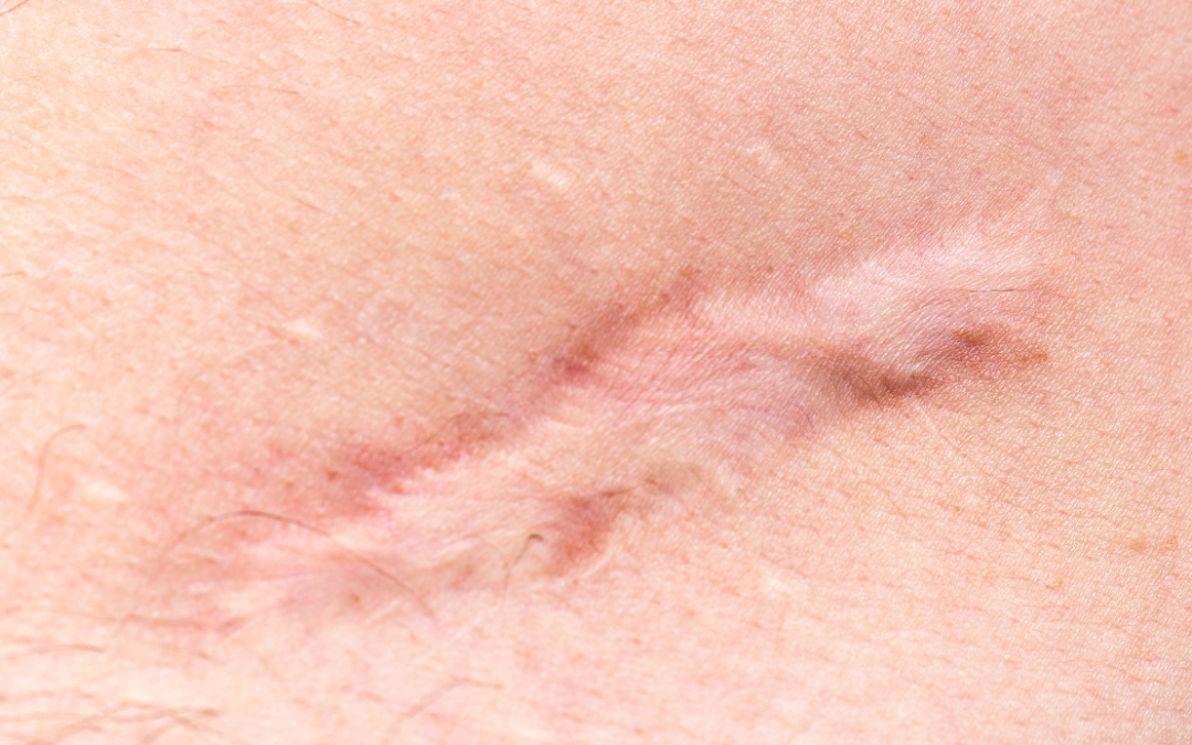 Scars
